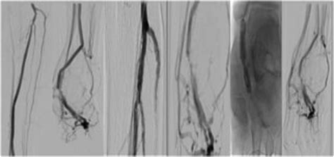 Intravascular Lithotripsy Assisted Percutaneous Deep Vein