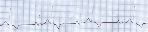 Ventricular bigeminy – All About Cardiovascular System and Disorders