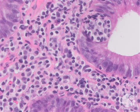 MALT/Extra-Nodal Marginal Zone Lymphoma H&E High Power