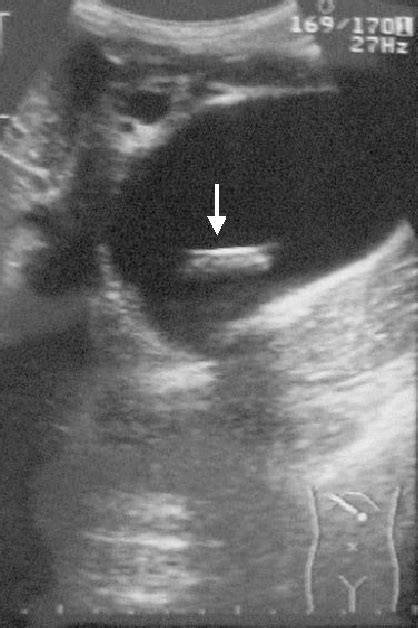 Figure 1 From A Case Of Obstructive Jaundice Caused By Impaction Of