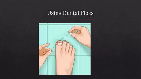 Management Of Ingrown Toe Nails Ppt