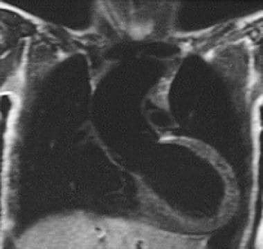 Truncus Arteriosus Imaging Practice Essentials Pathophysiology