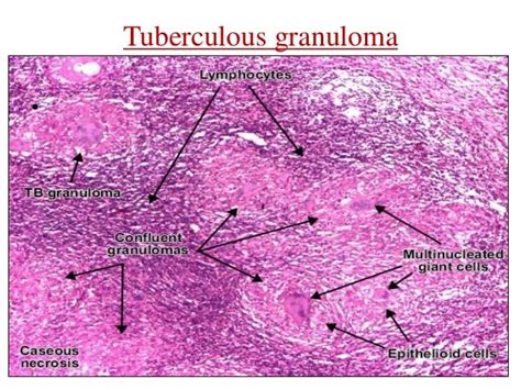 Tubercular lymphadenitis management