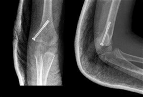 Lateral Condyle Fracture - Pediatric - Pediatrics - Orthobullets