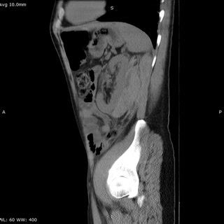 Case 1 30 YO Male Patient Had A PNB For Glomerulonephritis Histology