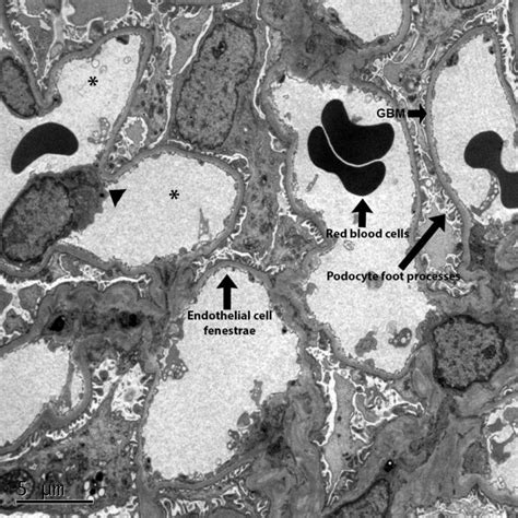 Kidney Biopsy Of The Month What Is Normal Renal Fellow Network