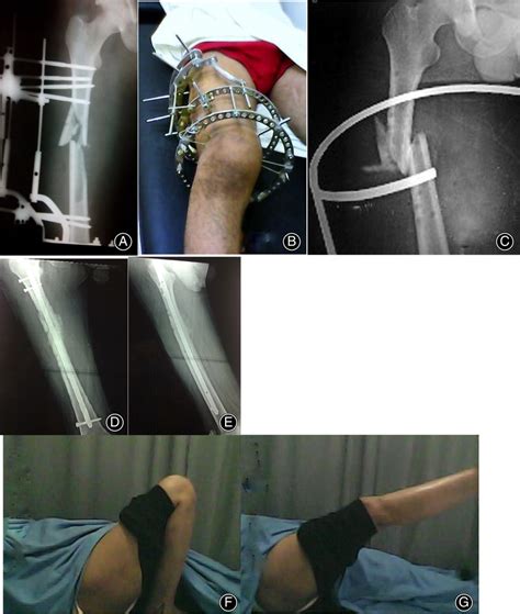 A And B Adult Male With Open Comminuted Shaft Femur Treated With Ring