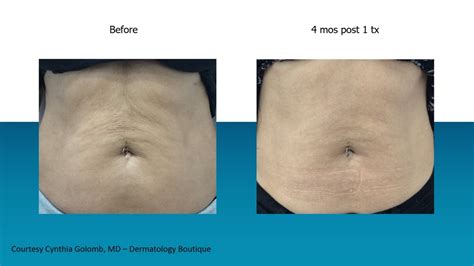 Microneedling Fort Lauderdale Genius Rf Microneedling