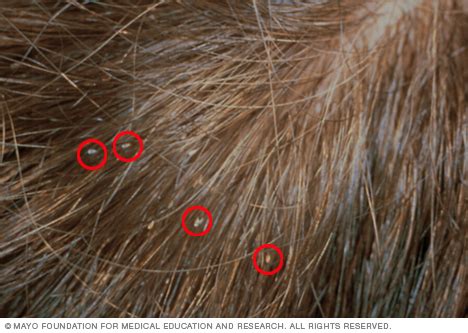 Lice Disease Reference Guide Drugs