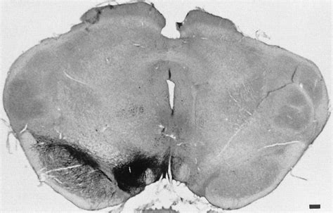 Reconstruction of the Nigrostriatal Pathway by Simultaneous ... 
