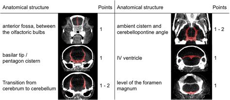 Longitudinal Imaging And Evaluation Of SAH Associated Cerebral Large