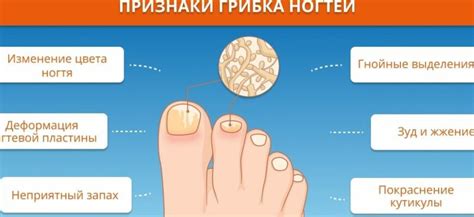 Виды грибка ногтей на ногах: симптомы, лечение, профилактика