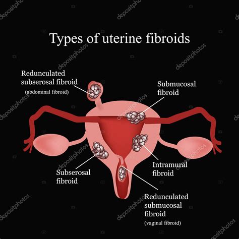 Tipos De Fibromas Uterinos Endometriosis Infografías Ilustración