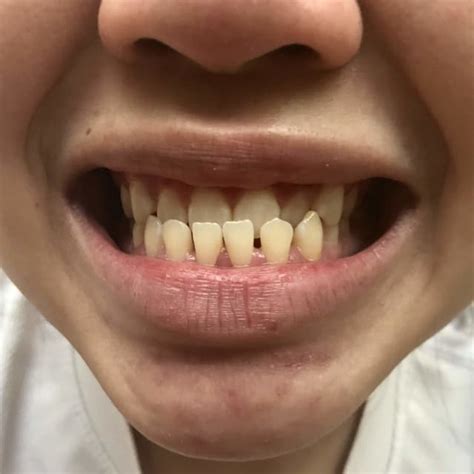 How To Fix Underbite With Braces NO MORE UNDERBITE ADULT UNDERBITE