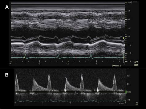 Transthoracic Echocardiography After Mv Repair A M Mode