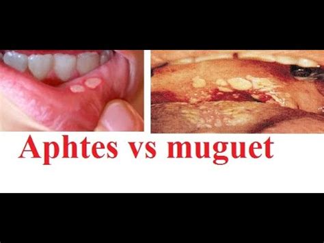 Aphtes Vs Muguet Youtube