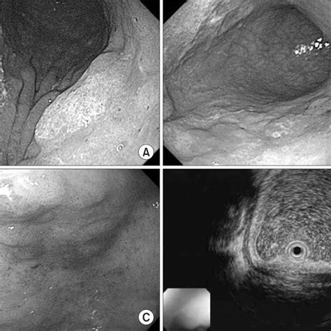 Two centimeter elevated mucosal lesion was revealed as HGD on the ...