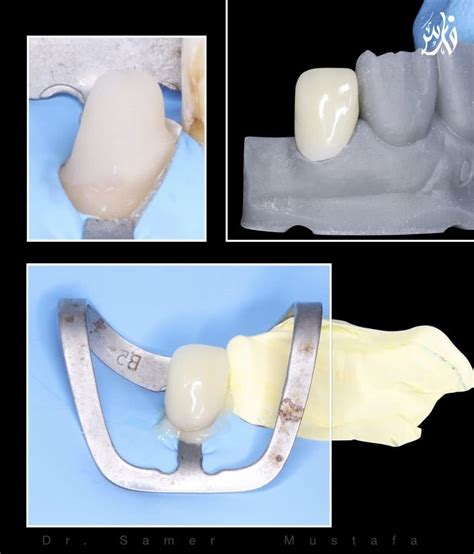 Last chance for severely damaged lateral incisor - MyZerodonto