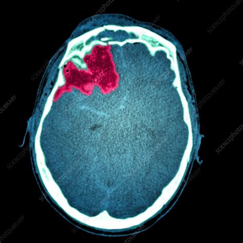 Brain Haemorrhage Ct Scan Stock Image M1360355 Science Photo