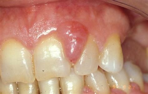 Intraoral View Of Gingival Overgrowth Open I