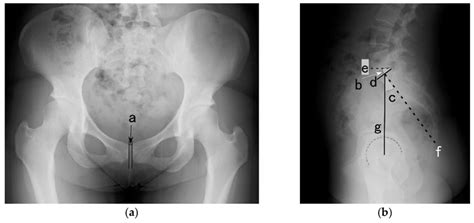 X Ray Of The Frontal Image Of Pubic Symphysis A And Sagittal Image Of