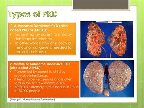 Polycystic kidney disease