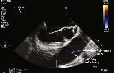 Pulmonary Valve in Health and Disease - Clinical Tree