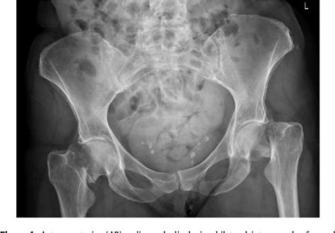 Figure 1 From Bilateral Simultaneous Neck Of Femur Fractures Arising