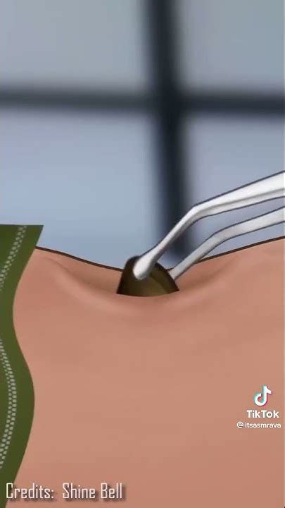 Asmr Navel Stone Removal Treatment Asmr Animation Subscribe Youtube