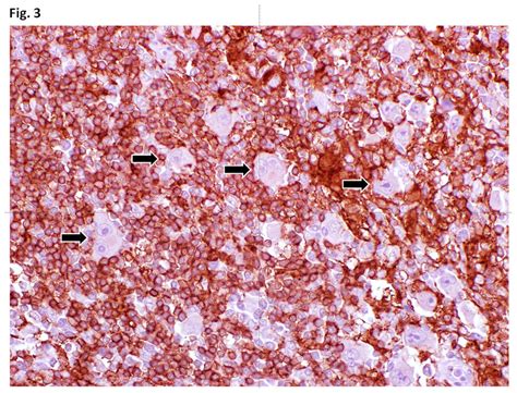 Immunohistochemical Staining Of The CYBB Protein In CHL Tissue