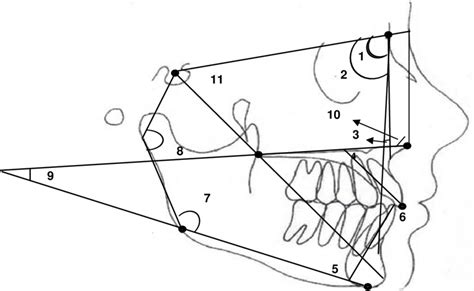 Angular Cephalometric Measurements 1 Sna 2 Snb 3 Anb 4 1 Pal 5 Download Scientific