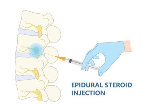 How Does An Epidural Steroid Injection Work For Pain Management Advanced Pain Institute Dfw