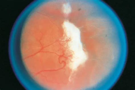 Retinopathy: Retinopathy Sickle Cell