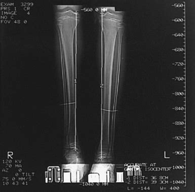 Long Bone Measurement Radiology Key