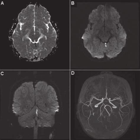 MRI of cerebellar stroke in a child one day after seasonal trivalent... | Download Scientific ...