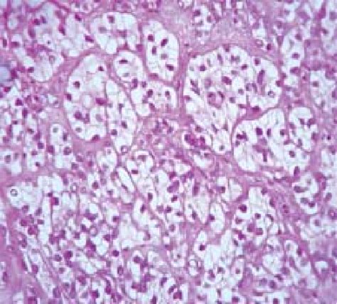 36 Acinic Cell Carcinoma Showing Clear Cells Arranged Acinar Pattern