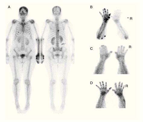 Figure From Asymmetrically Increased Uptake In Upper Extremities On