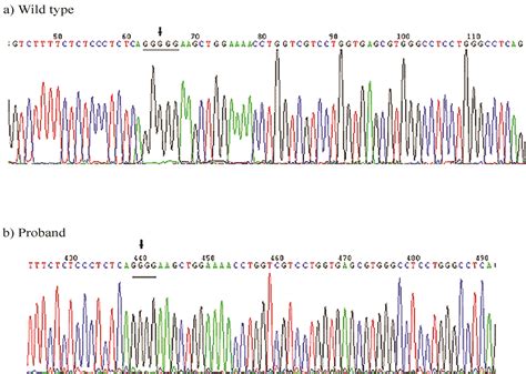 Scielo Brasil Identification Of A Novel Col A Frameshift Mutation