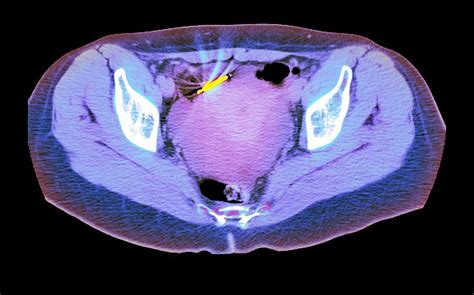 Ectopic Iud Contraceptive Ct Scan Photograph By Du Cane Medical