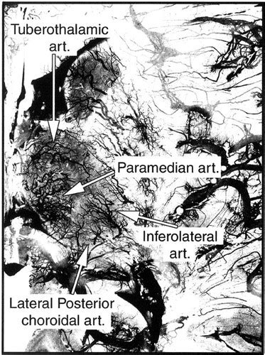 Vascular Syndromes Of The Thalamus Stroke