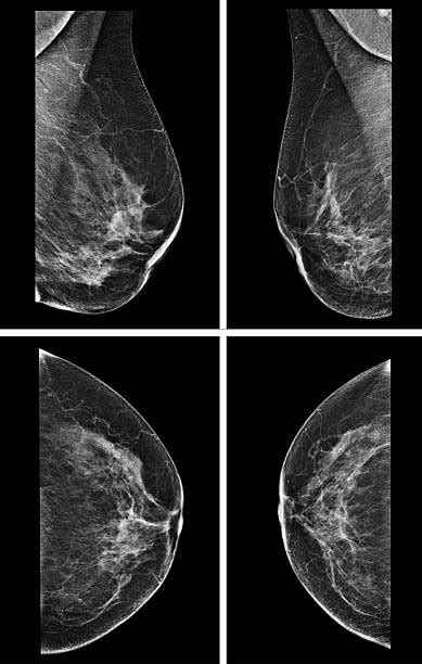 Mammogram Results Stock Photos, Pictures & Royalty-Free Images - iStock