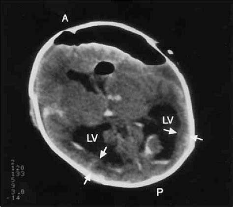 Figure 3 From Fetal Hydrocephalus Secondary To Intraventricular