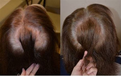 Finasteride Females Before And After Photos Hair Restoration Of The