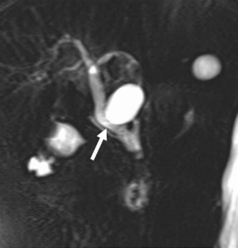 Cystic Duct Remnant Mucocele Magnetic Resonance Download