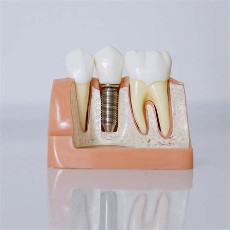 A Brief History Of Dental Implants Smart Dental Trip