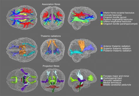 White Matter Tracts Of Interest Generated Using Probabilistic