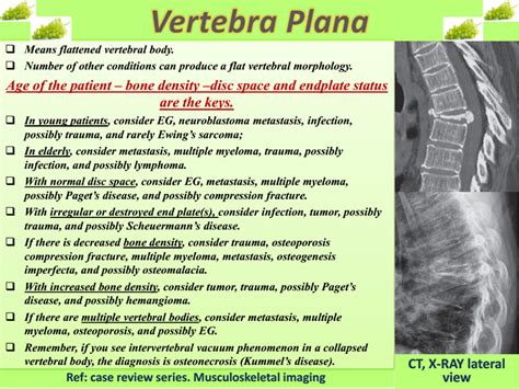 Easy Radiology: Vertebra plana