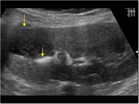 Milk Of Calcium Cyst Ultrasound