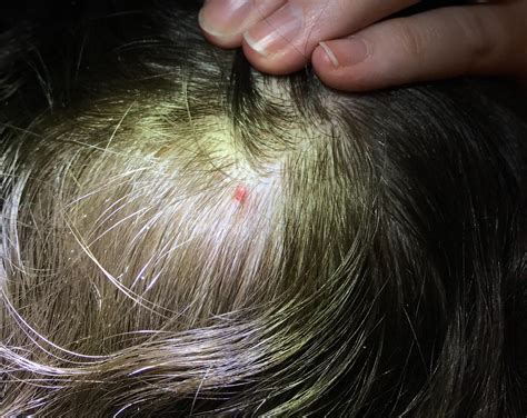 What Is This Small Red Bump On My Head It Is Tender Bleeds And Has Hung Around For A Couple