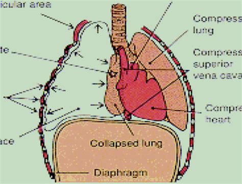 Respiratory Disorders Patho Flashcards Quizlet